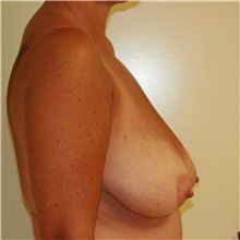 Breast Reduction Before Photo by Steve Laverson, MD, FACS; Rancho Santa Fe, CA - Case 40919