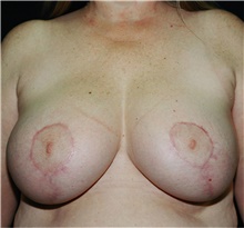 Breast Reduction After Photo by Steve Laverson, MD, FACS; Rancho Santa Fe, CA - Case 40921