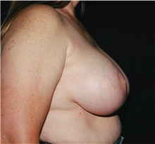 Breast Reduction After Photo by Steve Laverson, MD, FACS; San Diego, CA - Case 40921