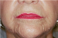 Lip Augmentation/Enhancement After Photo by Steve Laverson, MD, FACS; Rancho Santa Fe, CA - Case 40922