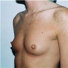 Breast Augmentation Before Photo by Steve Laverson, MD, FACS; Rancho Santa Fe, CA - Case 40942