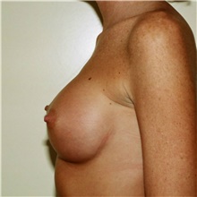 Breast Augmentation After Photo by Steve Laverson, MD, FACS; Rancho Santa Fe, CA - Case 40942