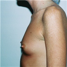 Breast Augmentation Before Photo by Steve Laverson, MD, FACS; Rancho Santa Fe, CA - Case 40942