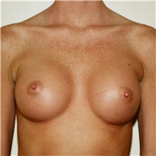 Breast Augmentation After Photo by Steve Laverson, MD, FACS; Rancho Santa Fe, CA - Case 40942