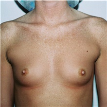 Breast Augmentation Before Photo by Steve Laverson, MD, FACS; Rancho Santa Fe, CA - Case 40942