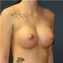 Breast Augmentation After Photo by Steve Laverson, MD, FACS; Rancho Santa Fe, CA - Case 40943