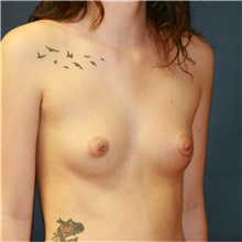 Breast Augmentation Before Photo by Steve Laverson, MD, FACS; Rancho Santa Fe, CA - Case 40943