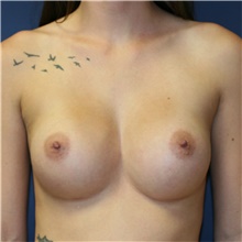 Breast Augmentation After Photo by Steve Laverson, MD, FACS; Rancho Santa Fe, CA - Case 40943