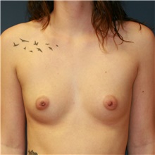 Breast Augmentation Before Photo by Steve Laverson, MD, FACS; Rancho Santa Fe, CA - Case 40943