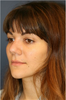 Rhinoplasty After Photo by Steve Laverson, MD, FACS; Rancho Santa Fe, CA - Case 40956