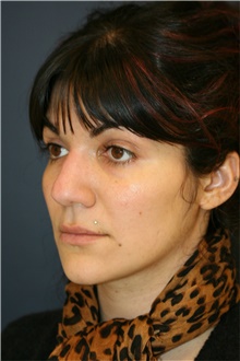 Rhinoplasty Before Photo by Steve Laverson, MD, FACS; Rancho Santa Fe, CA - Case 40956