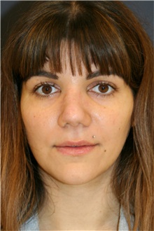 Rhinoplasty After Photo by Steve Laverson, MD, FACS; Rancho Santa Fe, CA - Case 40956