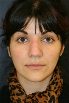 Rhinoplasty Before Photo by Steve Laverson, MD, FACS; Rancho Santa Fe, CA - Case 40956