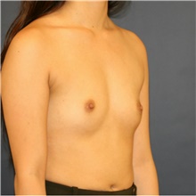 Breast Augmentation Before Photo by Steve Laverson, MD, FACS; Rancho Santa Fe, CA - Case 40958