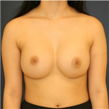 Breast Augmentation After Photo by Steve Laverson, MD, FACS; Rancho Santa Fe, CA - Case 40958