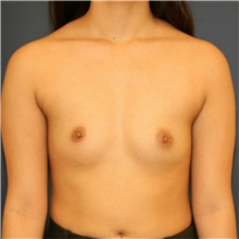 Breast Augmentation Before Photo by Steve Laverson, MD, FACS; Rancho Santa Fe, CA - Case 40958