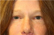 Brow Lift After Photo by Steve Laverson, MD, FACS; San Diego, CA - Case 40969