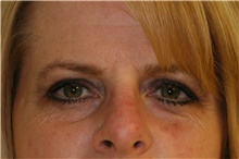 Brow Lift Before Photo by Steve Laverson, MD; San Diego, CA - Case 40970