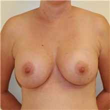 Breast Augmentation After Photo by Steve Laverson, MD, FACS; Rancho Santa Fe, CA - Case 40971