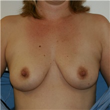 Breast Augmentation Before Photo by Steve Laverson, MD, FACS; Rancho Santa Fe, CA - Case 40971