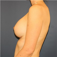 Breast Augmentation After Photo by Steve Laverson, MD, FACS; Rancho Santa Fe, CA - Case 40972