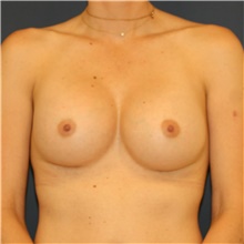 Breast Augmentation After Photo by Steve Laverson, MD, FACS; Rancho Santa Fe, CA - Case 40972