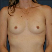 Breast Augmentation Before Photo by Steve Laverson, MD, FACS; Rancho Santa Fe, CA - Case 40972