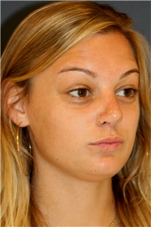 Rhinoplasty After Photo by Steve Laverson, MD, FACS; Rancho Santa Fe, CA - Case 40974