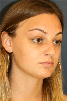 Rhinoplasty Before Photo by Steve Laverson, MD, FACS; Rancho Santa Fe, CA - Case 40974