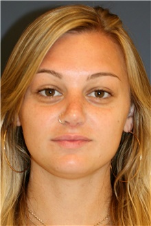 Rhinoplasty After Photo by Steve Laverson, MD, FACS; Rancho Santa Fe, CA - Case 40974