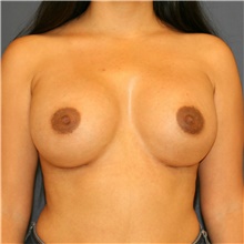 Breast Augmentation After Photo by Steve Laverson, MD, FACS; Rancho Santa Fe, CA - Case 40976