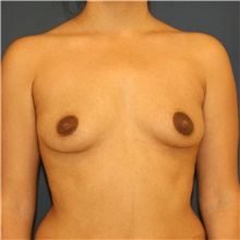 Breast Augmentation Before Photo by Steve Laverson, MD, FACS; Rancho Santa Fe, CA - Case 40976