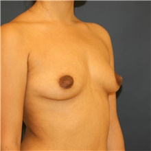 Breast Augmentation Before Photo by Steve Laverson, MD, FACS; Rancho Santa Fe, CA - Case 40976