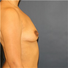 Breast Augmentation Before Photo by Steve Laverson, MD, FACS; Rancho Santa Fe, CA - Case 40976