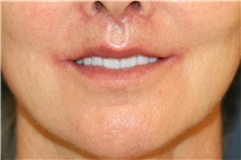 Lip Augmentation/Enhancement After Photo by Steve Laverson, MD, FACS; Rancho Santa Fe, CA - Case 41002