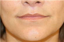 Lip Augmentation/Enhancement After Photo by Steve Laverson, MD, FACS; Rancho Santa Fe, CA - Case 41003