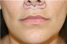 Lip Augmentation/Enhancement Before Photo by Steve Laverson, MD, FACS; Rancho Santa Fe, CA - Case 41003