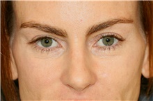 Eyelid Surgery After Photo by Steve Laverson, MD; San Diego, CA - Case 41004