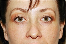 Eyelid Surgery After Photo by Steve Laverson, MD, FACS; Rancho Santa Fe, CA - Case 41005