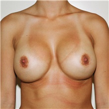 Breast Augmentation After Photo by Steve Laverson, MD, FACS; Rancho Santa Fe, CA - Case 41016