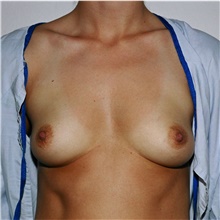 Breast Augmentation Before Photo by Steve Laverson, MD, FACS; Rancho Santa Fe, CA - Case 41016