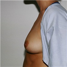 Breast Augmentation Before Photo by Steve Laverson, MD, FACS; Rancho Santa Fe, CA - Case 41016