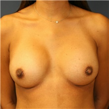 Breast Augmentation After Photo by Steve Laverson, MD, FACS; San Diego, CA - Case 41017