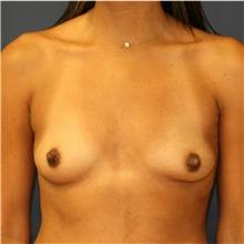 Breast Augmentation Before Photo by Steve Laverson, MD, FACS; San Diego, CA - Case 41017