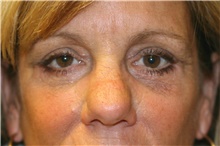 Eyelid Surgery After Photo by Steve Laverson, MD; San Diego, CA - Case 41023
