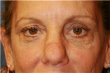 Eyelid Surgery Before Photo by Steve Laverson, MD; San Diego, CA - Case 41023