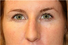 Eyelid Surgery After Photo by Steve Laverson, MD; San Diego, CA - Case 41024