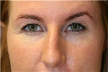 Eyelid Surgery Before Photo by Steve Laverson, MD; San Diego, CA - Case 41024