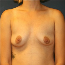 Breast Augmentation Before Photo by Steve Laverson, MD, FACS; Rancho Santa Fe, CA - Case 41050