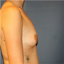 Breast Augmentation Before Photo by Steve Laverson, MD, FACS; Rancho Santa Fe, CA - Case 41050